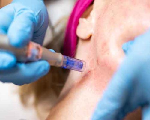 Derma - needling Neck add - on
